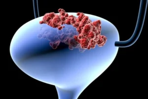 Nguyên nhân gây ra ung thư bàng quang ở đàn ông